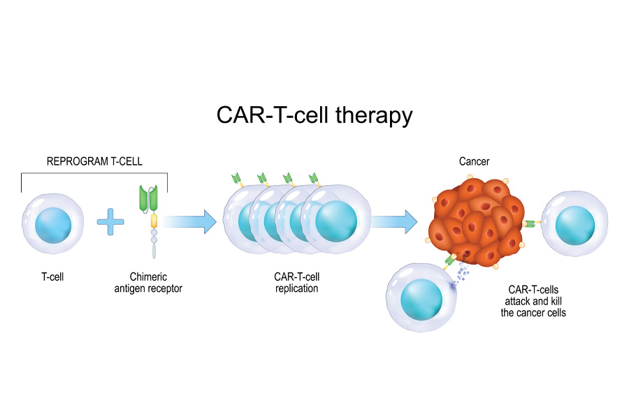 Proceso de CAR T-Cells.