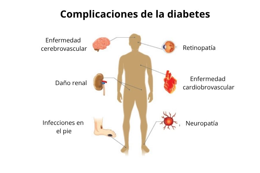 Infografía que muestra las principales complicaciones de la diabetes mellitus: enfermedad cerebrovascular, retinopatía y ceguera, daño renal permanente, infarto al corazón, infecciones en el pie diabético y neuropatía periférica, señaladas en distintas partes del cuerpo humano.