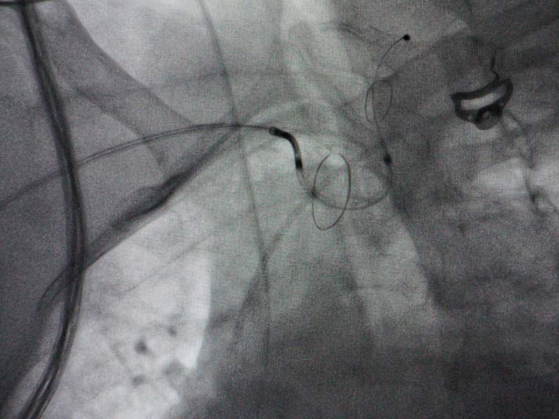 El dispositivo de protección embólica puede ser usado en cualquier intervención cardiovascular mínimamente invasiva a través de catéteres.