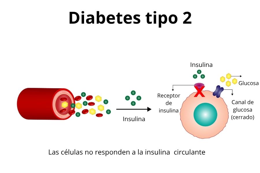 Infografía que muestra cómo, en la diabetes tipo 2, la insulina no logra abrir los receptores de la célula, el canal de la glucosa permanece cerrado y la glucosa se queda en la sangre