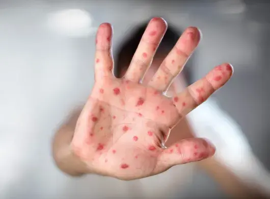 What is measles? Symptoms, prevention, and about the health alert