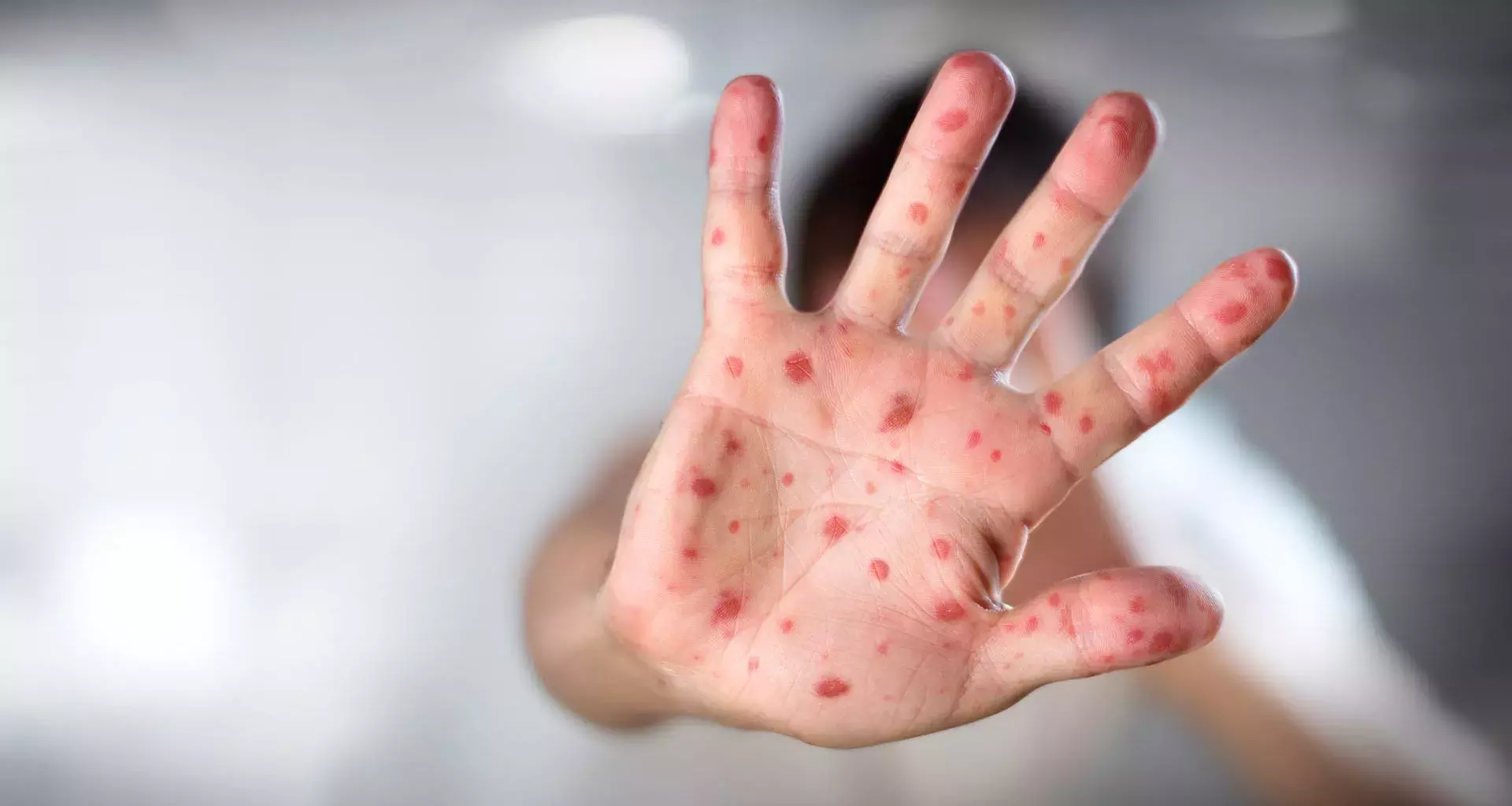 What is measles? Symptoms, prevention, and about the health alert