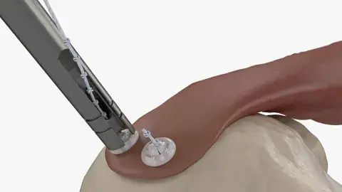 Crea botones quirúrgicos para reparar tendones y ligamentos