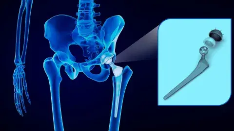 ¡Tecnología 3D! Con realidad aumentada buscan apoyar cirugía de pelvis