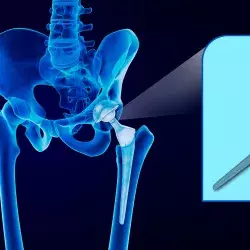 ¡Tecnología 3D! Con realidad aumentada buscan apoyar cirugía de pelvis